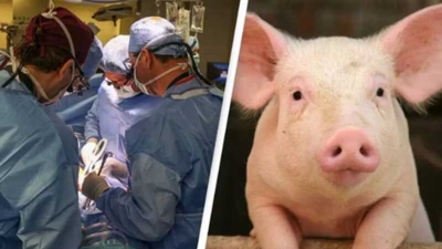 Впервые в мире живому человеку пересадили почку свиньи